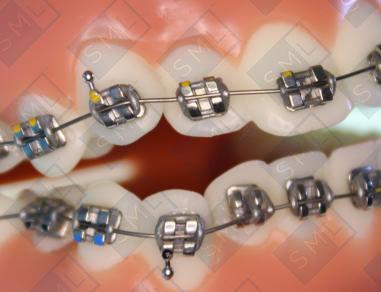 Stainless-Steel Arch Wires